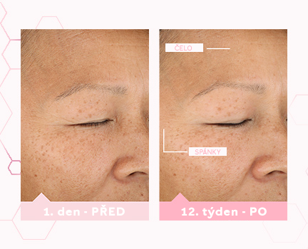 Obrázky před a potom (z 1. dne a 12. týdne) ukazující průměrné zlepšení pleti na čele a spánku po použití TimeWise zázračné sady